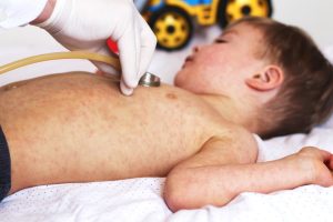 Viral,disease.,measles,rash.,concept,doctor,and,patient.,child,with